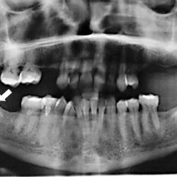 Radiopaque lesions of the mandible