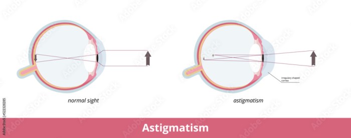 Cornea light eye refracts lens diagram