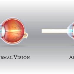 Malcurvature of the cornea leading to blurred vision is