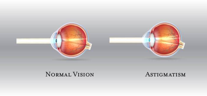 Malcurvature of the cornea leading to blurred vision is