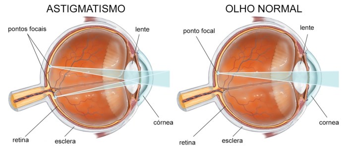 Malcurvature of the cornea leading to blurred vision is